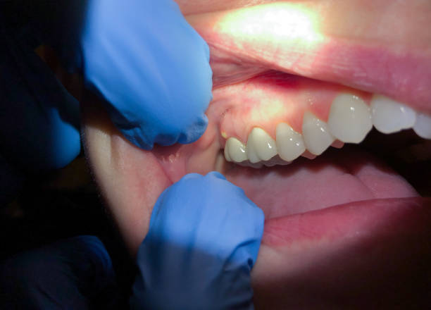 Best Lost Filling or Crown Replacement in Walterboro, SC