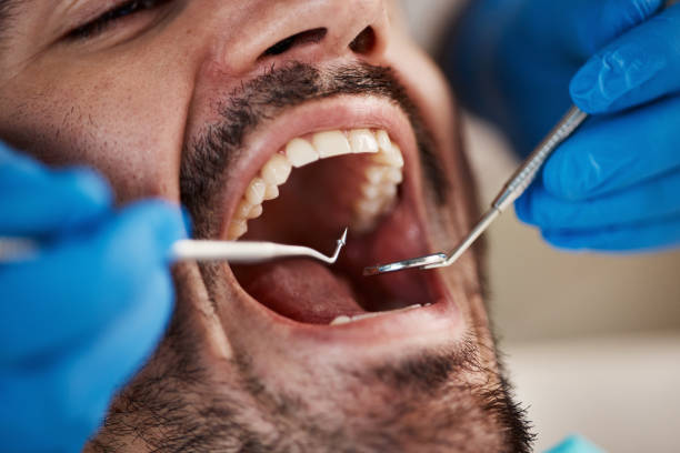 Best Knocked-Out Tooth (Avulsed Tooth) Treatment in Walterboro, SC